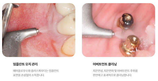 천안 치아교정, 불당본점 서울비디치과의원에서 시간과 비용을 아끼는 인비절라인 치아교정